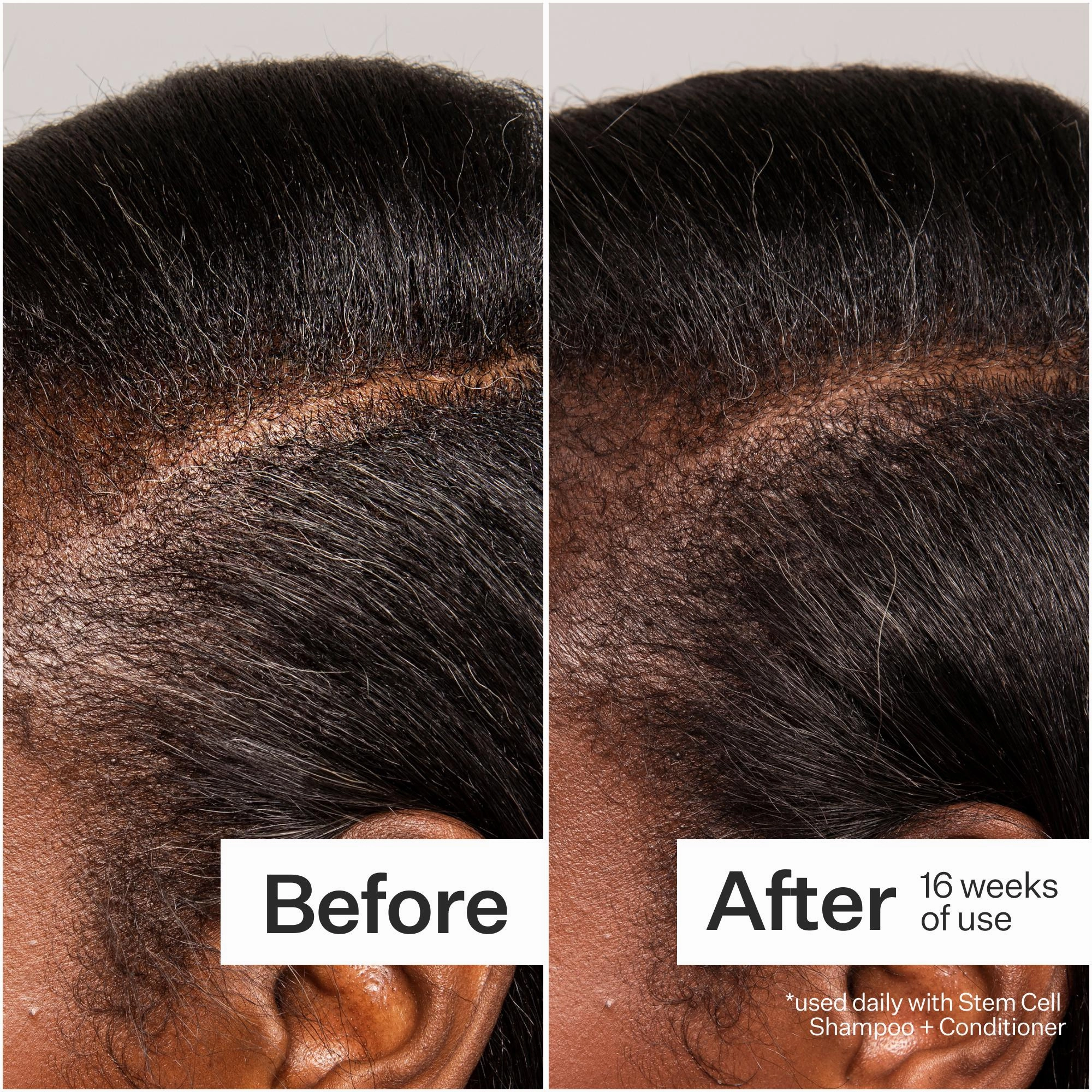 Act Acre 3% Stem Cell Peptide Treatment